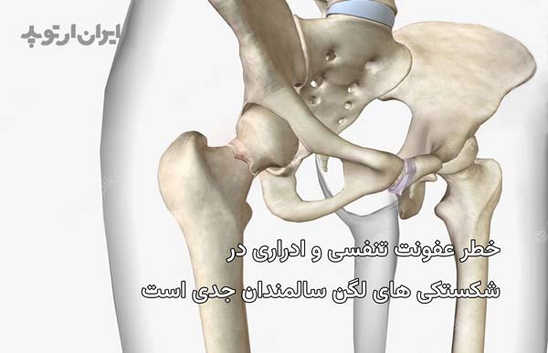 خطر عفونت تنفسی و ادراری در شکستگی لگن بزرگسالان زیاد است