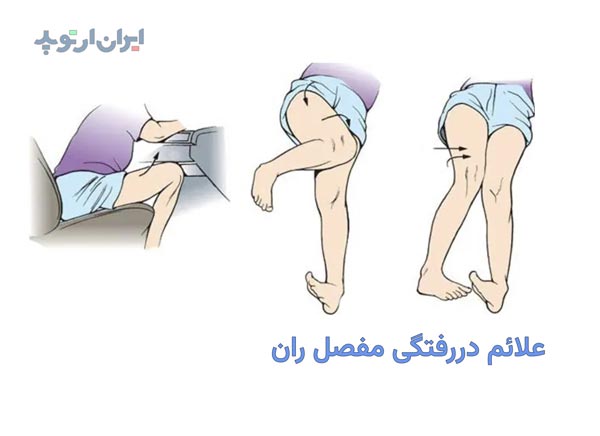 علائم دررفتگی مفصل ران چیست