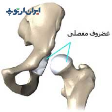 غضروف مفصل ران