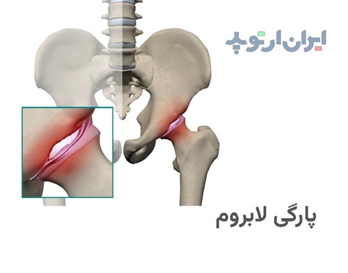   گیر کردن لابروم بین سر استخوان ران و لبه استابولوم و بدنبال آن پاره شدن لابروم