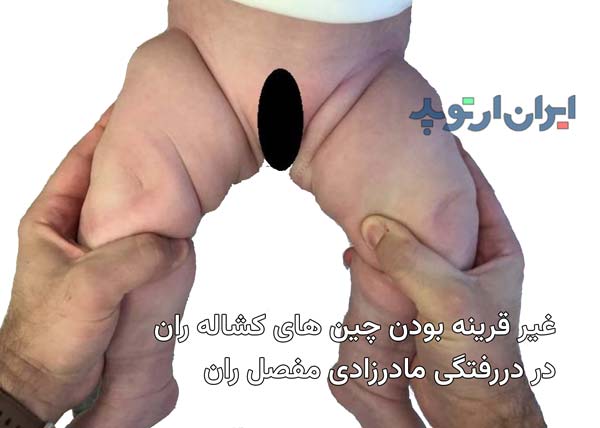 چین های کشاله ران غیر قرینه از علائم دررفتگی مادرزادی لگن است