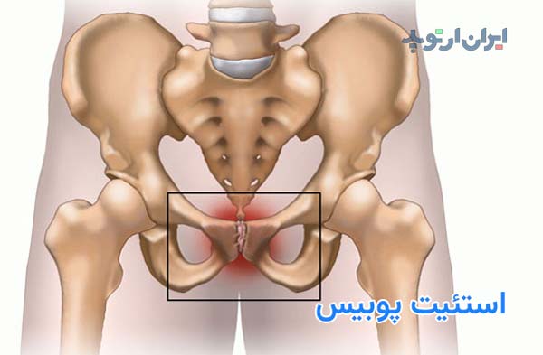 استئیت پوبیس چیست