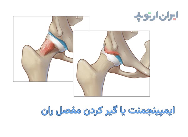 ایمپینجمنت یا گیر کردن مفصل ران چیست