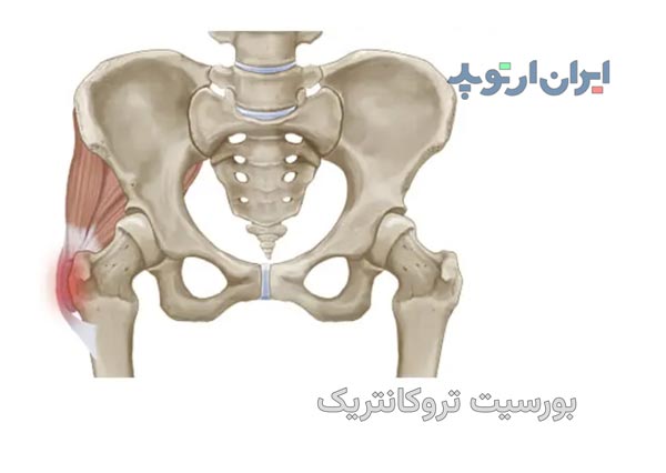 بورسیت تروکانتریک چیست و چگونه درمان میشود