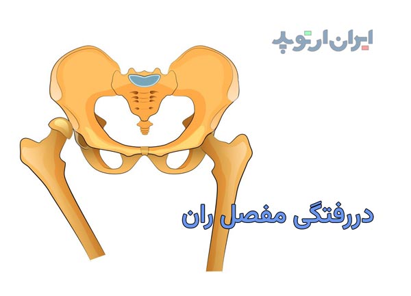 دررفتگی مفصل ران چیست و چگونه درمان میشود