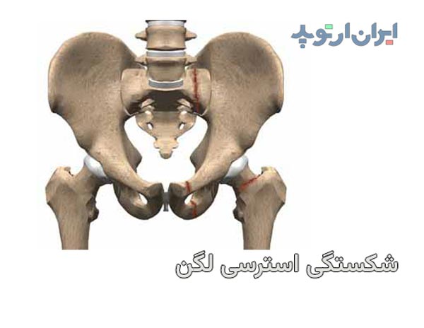 شکستگی استرسی لگن چیست