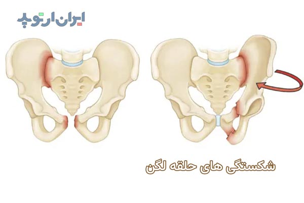 شکستگی در ناحیه حلقه لگنی چه خصوصیاتی دارد