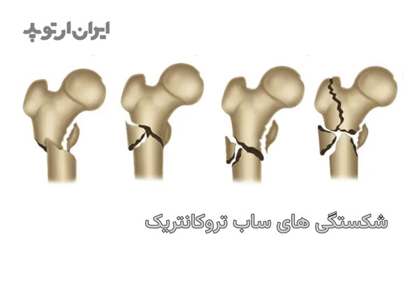 شکستگی ساب تروکانتریک چیست و چگونه درمان میشود