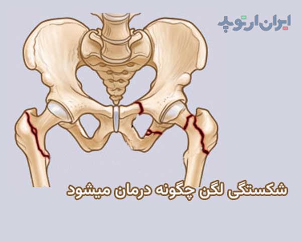 شکستگی لگن چیست و چگونه درمان میشود