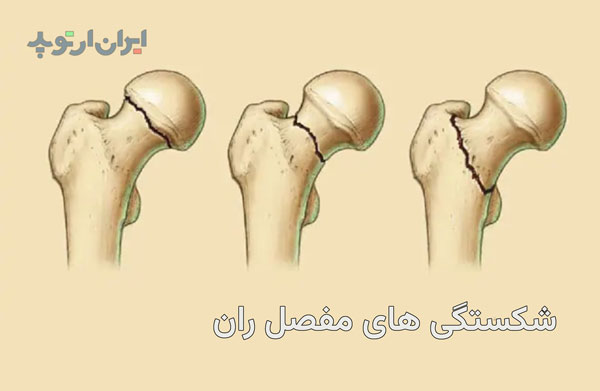 شکستگی مفصل ران چیست