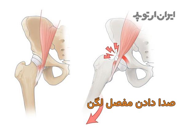 علت صدا دادن مفصل لگن و درمان آن چیست