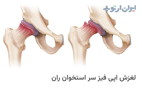 لغزش اپی فیز سر استخوان ران یا بیماری اسلیپ چیست