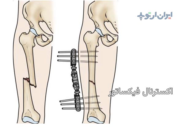 اکسترنال فیکساتور