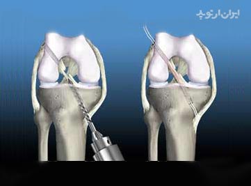 جراحی پارگی رباط صلیبی قدامی