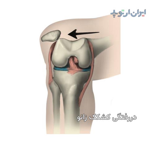 در رفتگی کشکک زانو