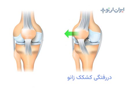 دررفتگی کشکک زانو به سمت بیرون