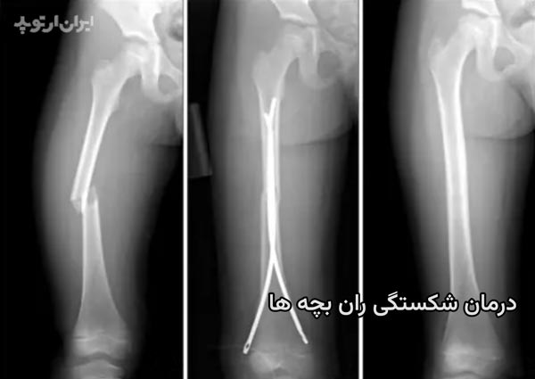 درمان شکستگی ران در بچه ها چگونه است