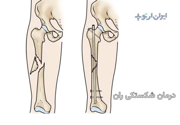 درمان شکستگی ران