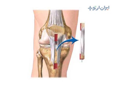 عمل پارگی رباط صلیبی