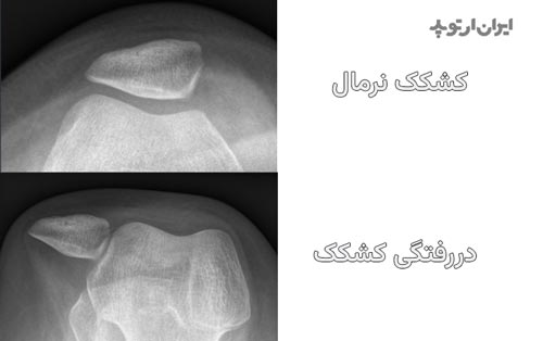 در رفتگی کشکک زانو