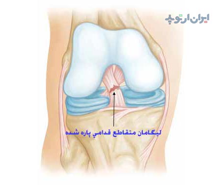 پاره شدن رباط صلیبی زانو