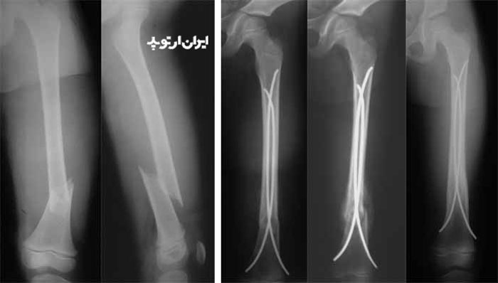 درمان شکستگی فمور در کودکان با میله داخل استخوان ران