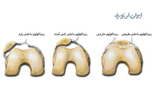 پارگی رتیناکولوم در دررفتگی کشکک زانو