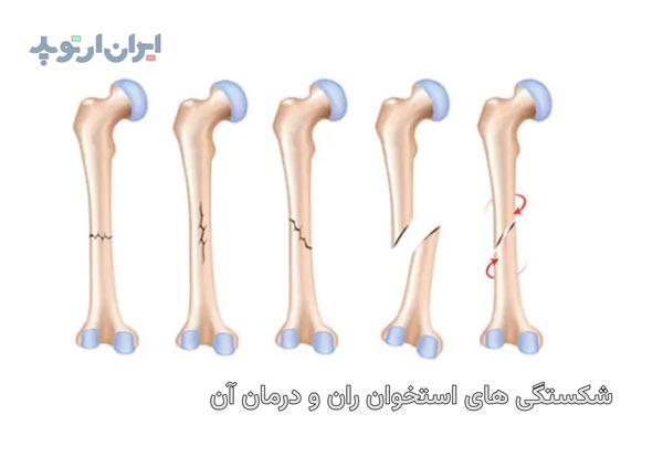 شکستگی های استخوان ران و فمور و درمان