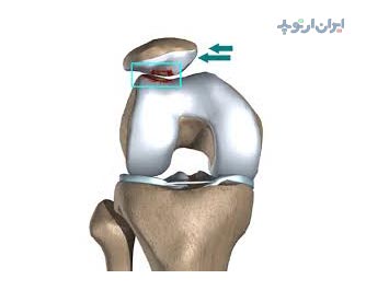 نرمی غضروف زانو