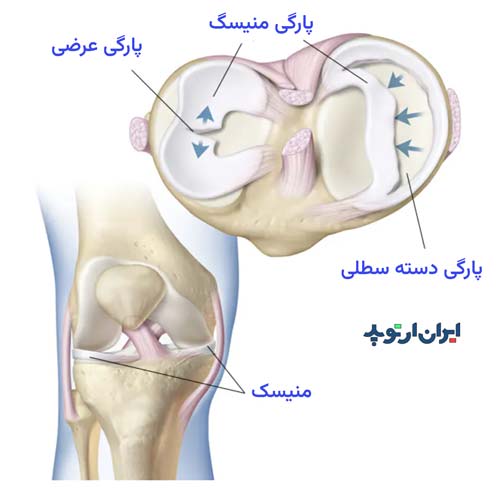 انواع پارگی منیسک زانو