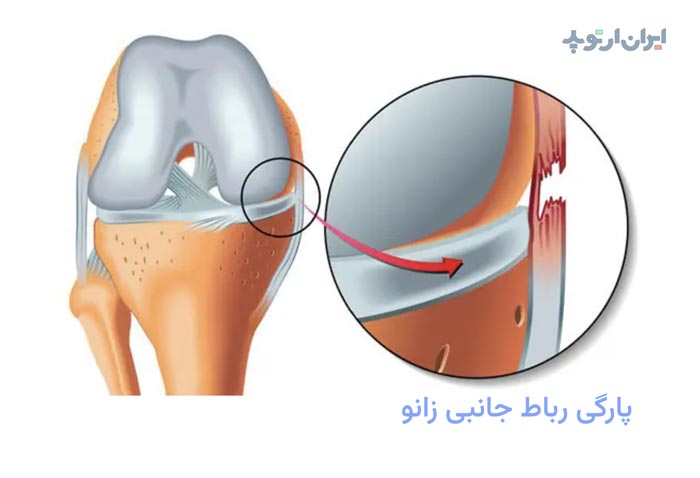 پارگی رباط جانبی زانو چگونه درمان میشود