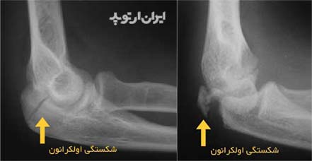 شکستگی آرنج در ناحیه اولکرانون