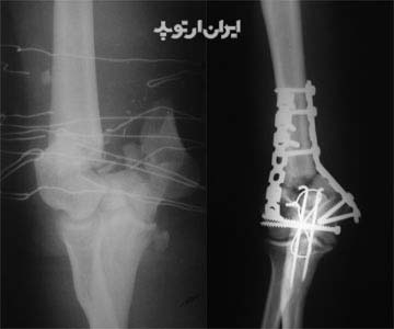 درمان جراحی شکستگی آرنج در ناحیه سوپراکندیلر